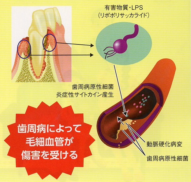 歯周病によって毛細血管が傷害を受ける