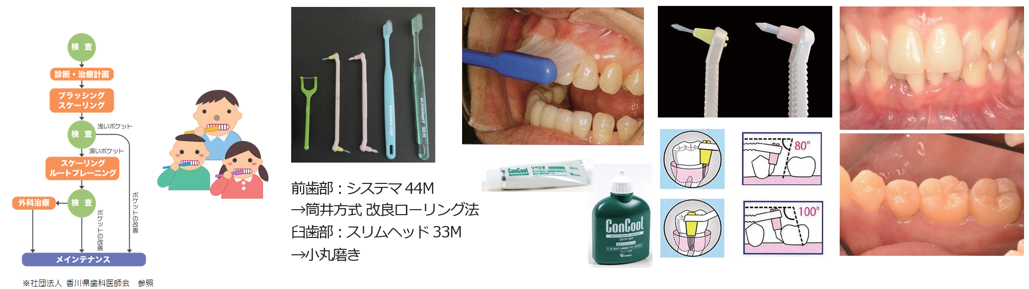 歯周基本治療の流れ